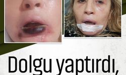 Dolgu yaptırdı, dudağı çürüdü! Talihsiz kadın o süreci anlattı