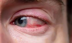 Gözde ışık çakması ve perde inmesine dikkat! Bu belirtiler ciddi hastalığın habercisi olabilir