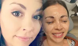 20 yıl makyajla uyudu: Göz kapağı göz küresine yapıştı