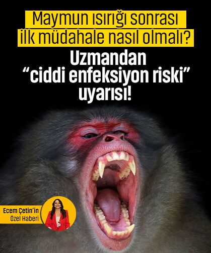 Maymun ısırığı sonrası ilk müdahale nasıl olmalı?  Uzmandan “ciddi enfeksiyon riski” uyarısı!