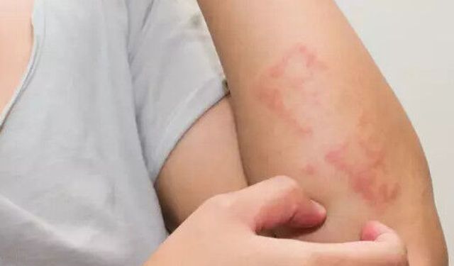 Alerji kaşıntısı nasıl olur? Belirtiler ve nedenleri