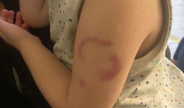 Edirne'de kreşte şoke eden iddia: Öğretmen 3 yaşındaki çocuğu öperken ısırdı