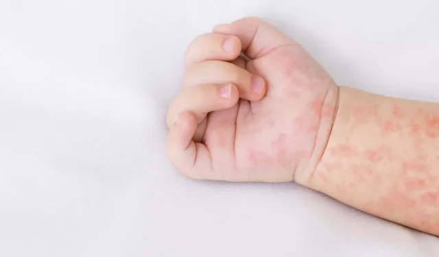 Altıncı hastalık nedir, belirtileri nelerdir ve nasıl tedavi edilir?