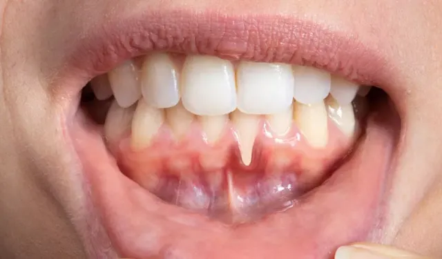 Diş eti çekilmesi (periodontitis) nedir, neden olur ve nasıl tedavi edilir?