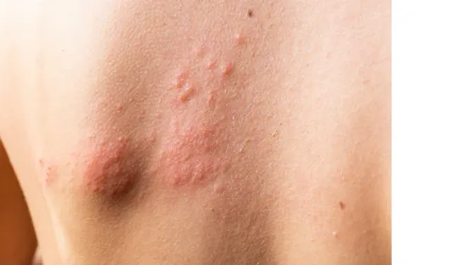 Histamin nedir, ne işe yarar? Histamin intoleransı belirtileri, nedenleri ve tedavi yöntemleri