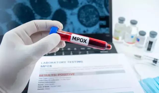 Maymun çiçeği alarmı! Yeni varyant tespit edildi