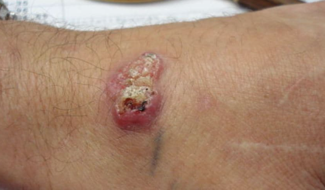 Hipoekoik lezyon nedir, hangi durumlarda görülür?