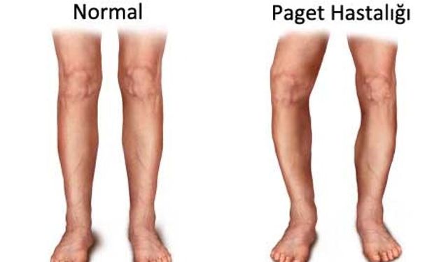 Paget hastalığı nedir? Paget hastalığı kimlerde görülür?