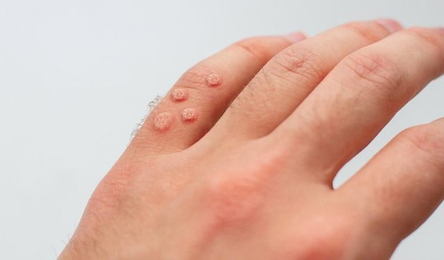 Siğil nasıl geçer? En etkili yöntemler, tedavi seçenekleri ve uzman ipuçları