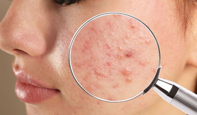 Sivilce nasıl geçer? Sivilce bir gecede geçer mi?