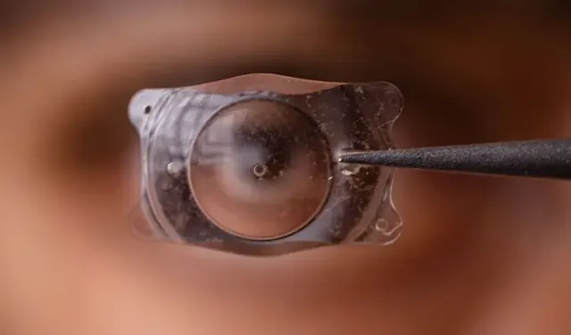 Smile lazer nedir, nasıl uygulanır?