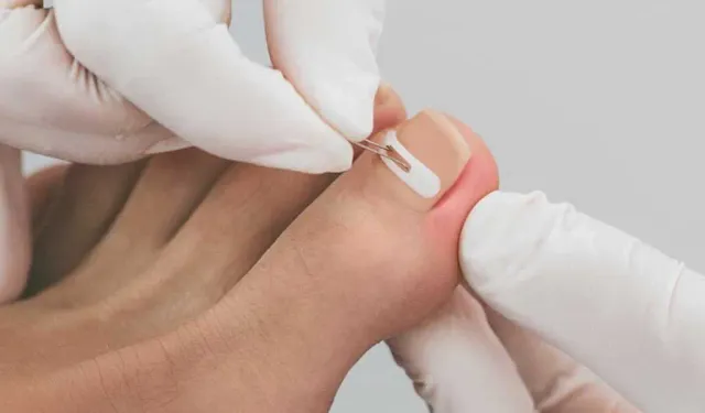 Tırnak mantarının belirtileri, erken teşhis hayat kurtarır