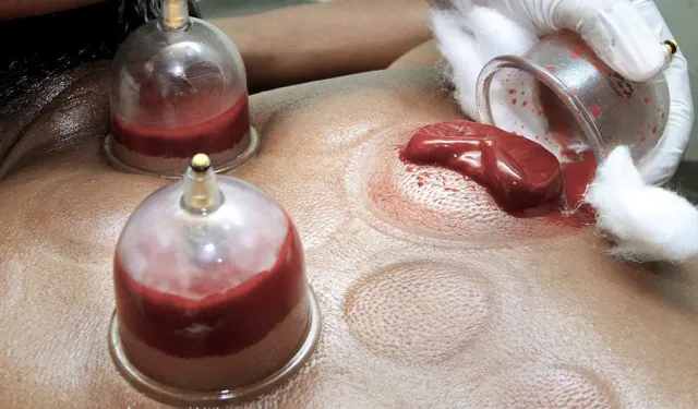 Hacamat nasıl yapılır? Hacamat kimlere yapılır, kimlere önerilmez?