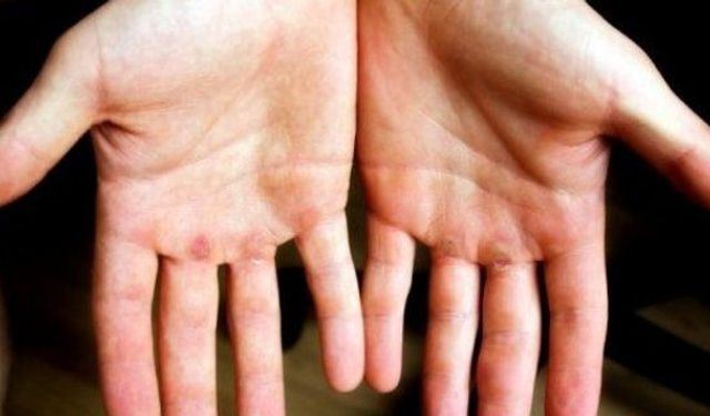 El nasırı nasıl geçer? El nasırına karşı evde uygulanabilecek yöntemler nelerdir?
