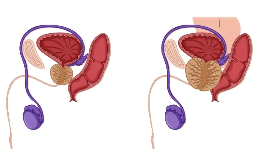 Prostat nedir? Prostat neden olur? Prostat belirtileri nelerdir?