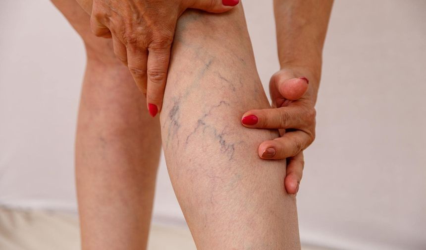 Venöz yetmezliği nedir, nasıl teşhis edilir? Belirtileri ve tedavisi