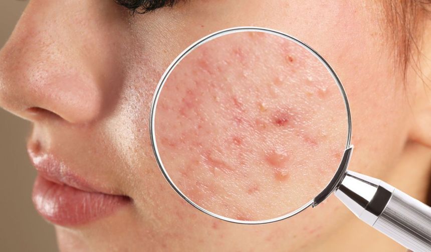 Sivilce tedavi yöntemleri, nasıl geçer?