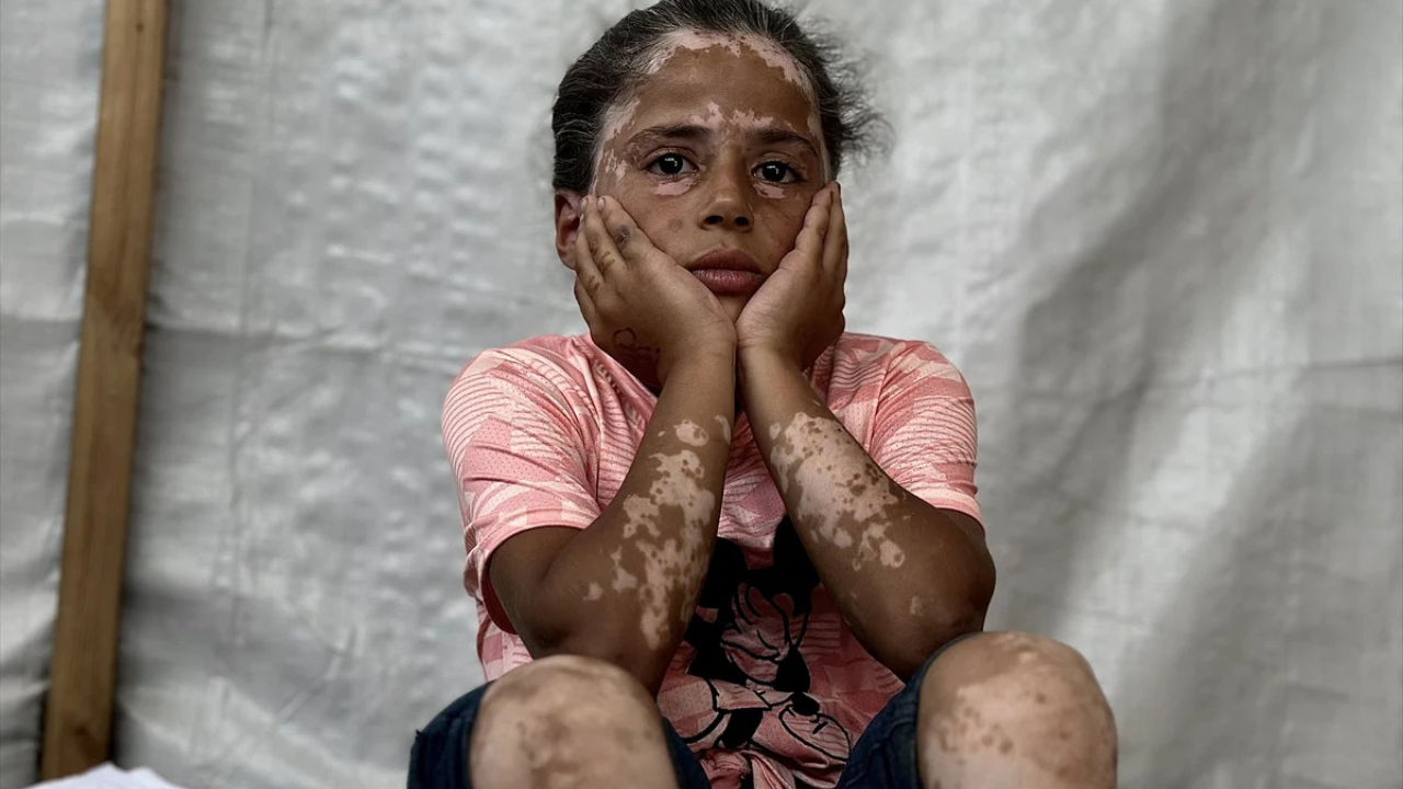 10 Yaşındaki Gazzeli Lana Vitiligo Oldu (1)