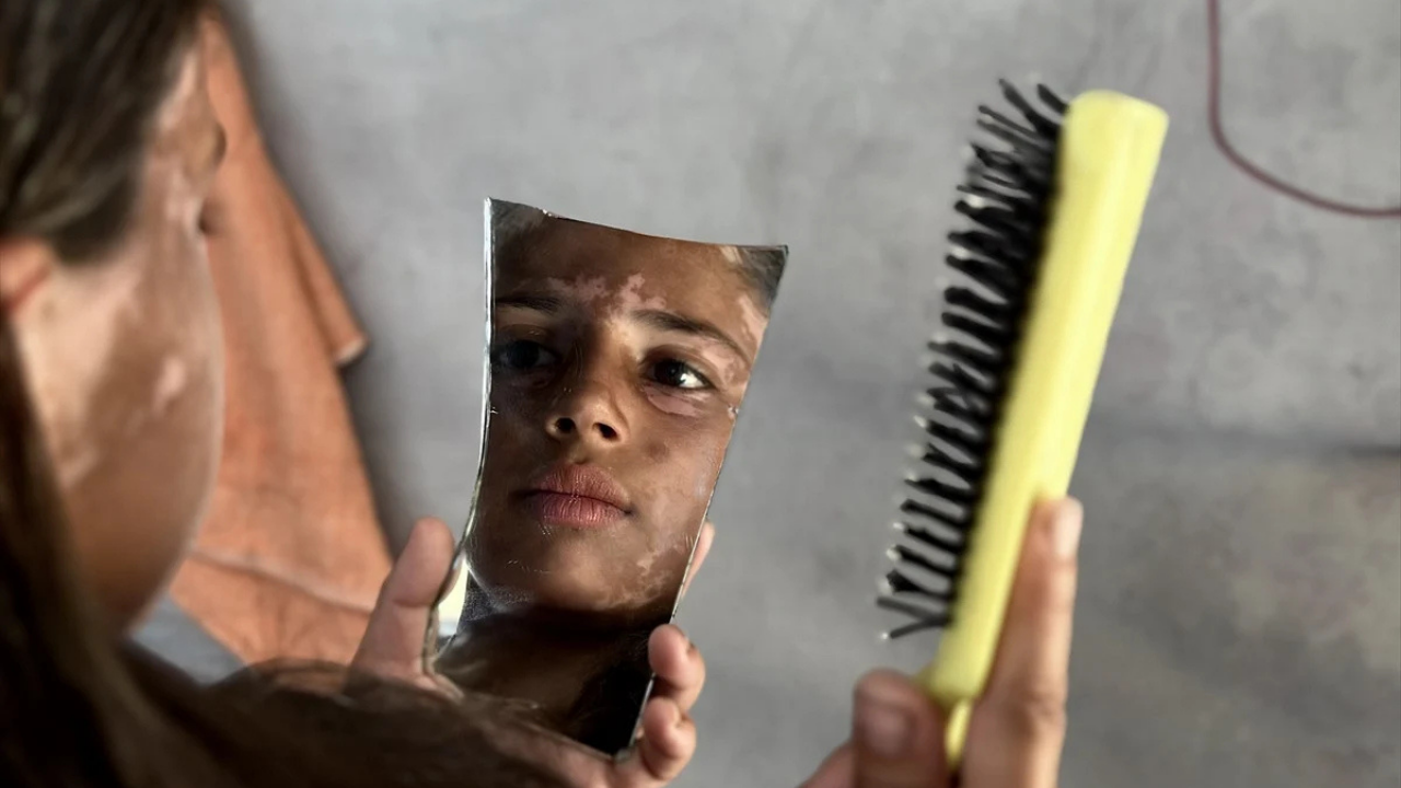 10 Yaşındaki Gazzeli Lana Vitiligo Oldu (2)