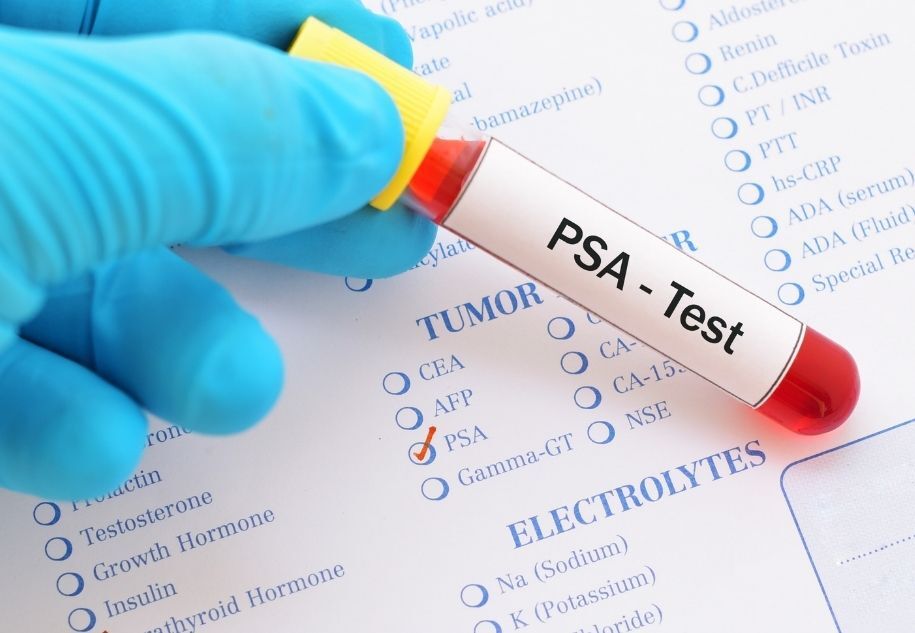 Psa Testi