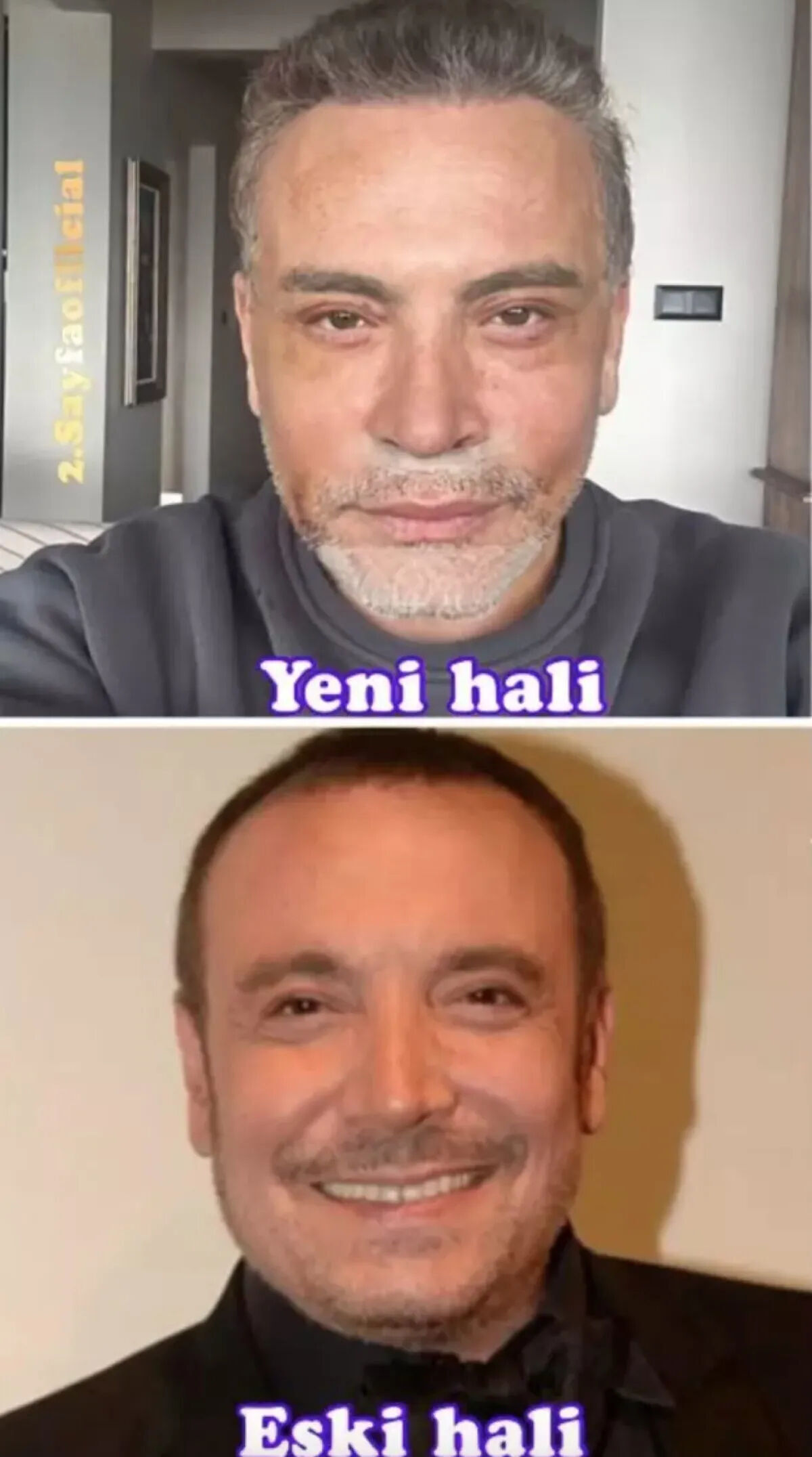 Yuz Gerdirme Operasyonu Sonrasi Cenk Erenin Son Hali Olay Oldu Elestiri Yagdi 17498157542757 3