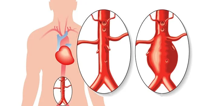 Anevrizma Aortic Aneurysm