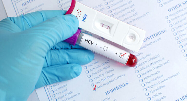 Anti Hcv Negatif