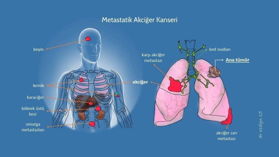 Evre Kanser Nedir Metastaz Ne Demektir Kanser Neden Metastaz Yapar 817749 966 544