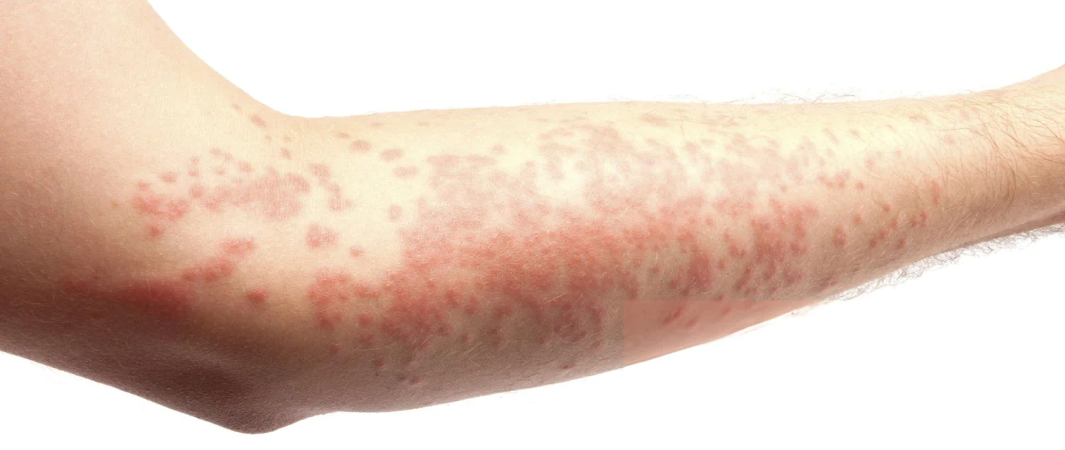 Histamin Intorelansi 1