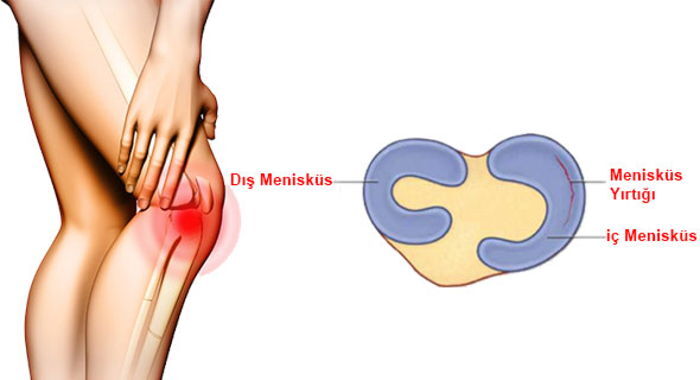 Menisküs Yırtığı