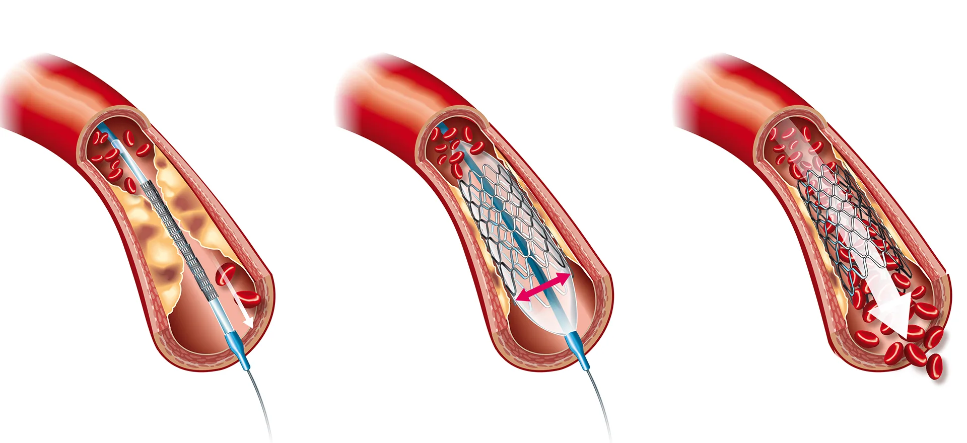 Stent Takilmasi Bypass Ameliyatini Engeller Mi