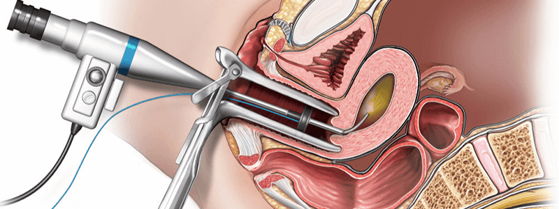 Ablasyon Nedir