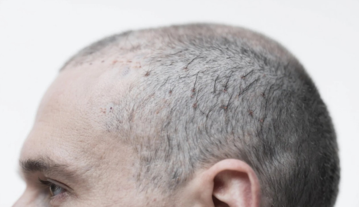Alopesi Nedir2
