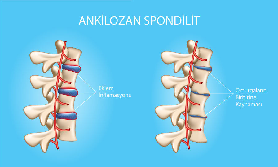 Ankilozan Spondilit Nedir 1