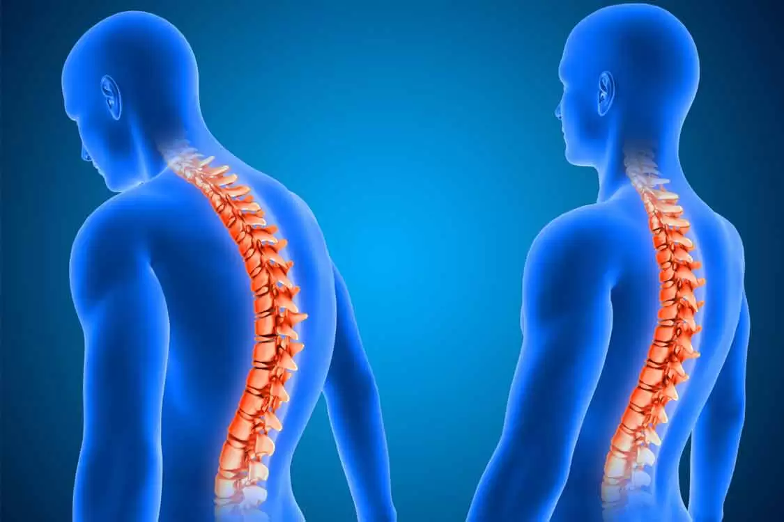 Ankilozan Spondilit Nedir 3