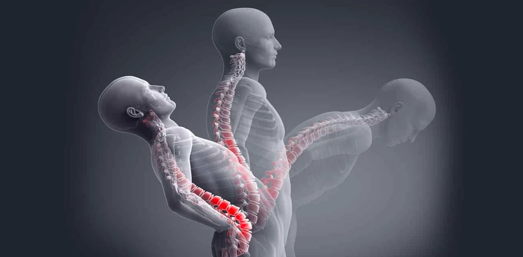 Ankilozan Spondilit Nedir 4