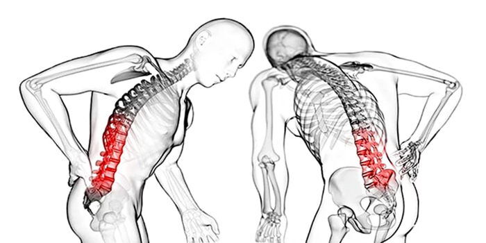 Ankilozan Spondilit Nedir
