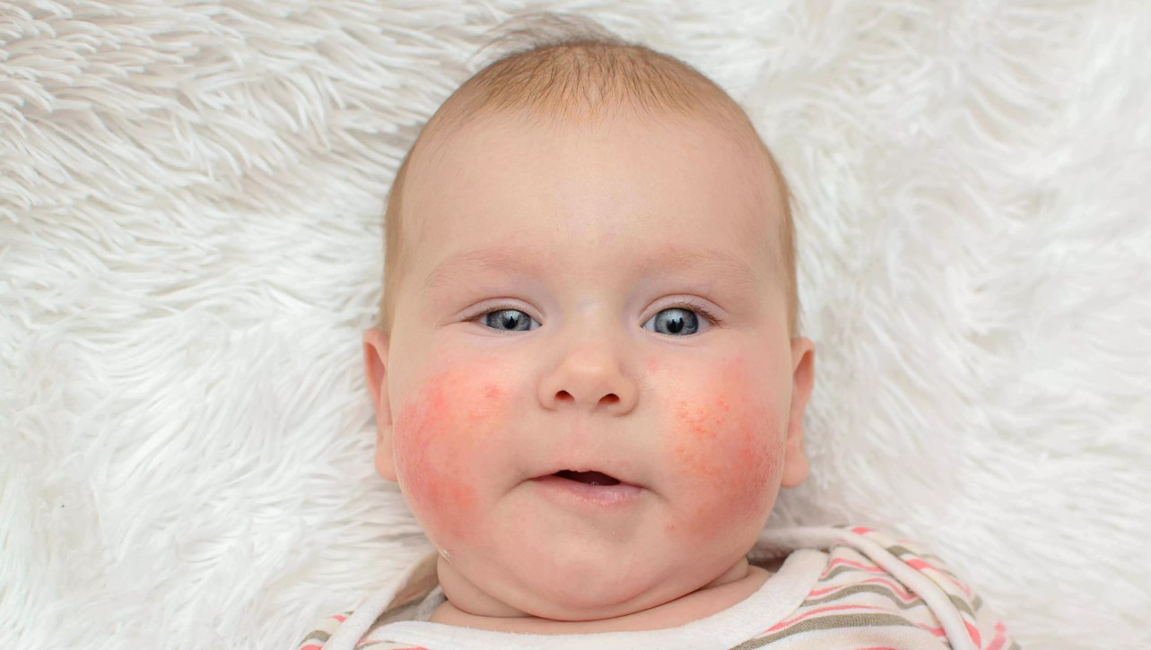 Atopik Dermatit Nedir Nedenleri, Belirtileri Ve Tedavisi