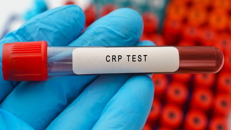 C Reaktif Protein Nedir 1