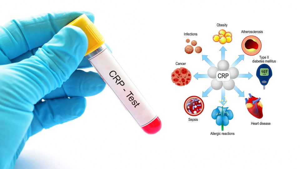 C Reaktif Protein Nedir