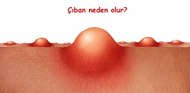 Çıban Nedir 1