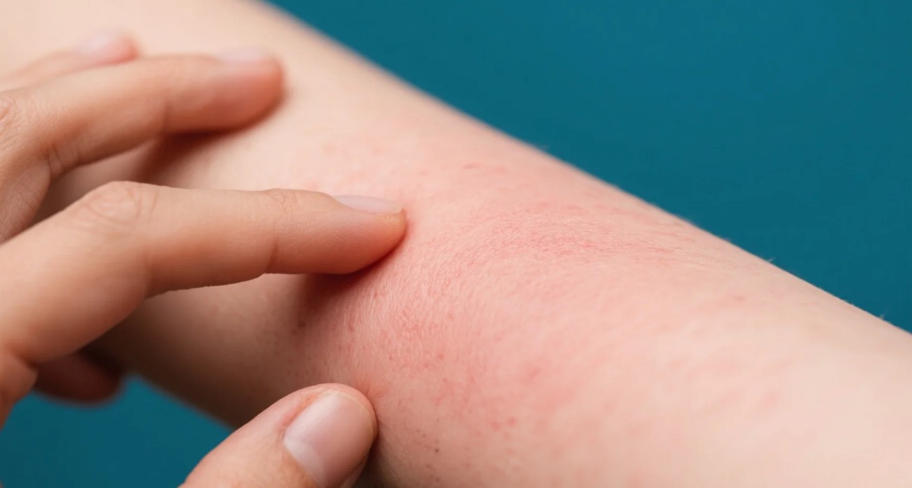 Dermatit Nedir2