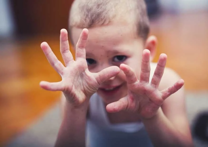 El Ayak Hastalığı Nedir 3