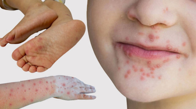 El Ayak Hastalığı Nedir 5