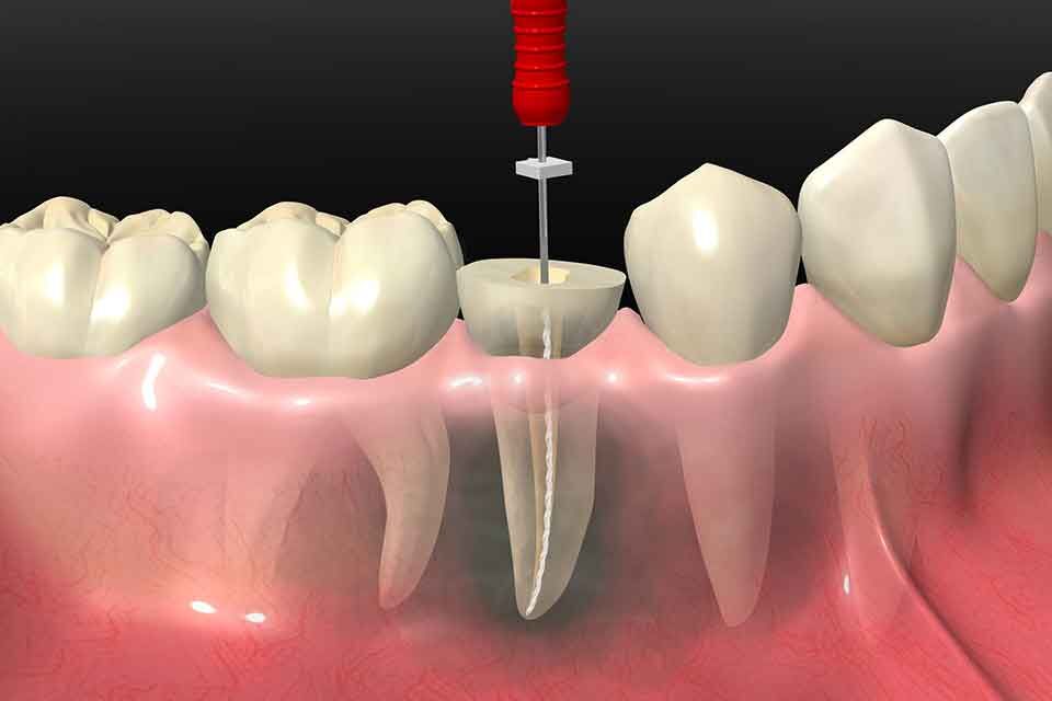 Endodonti 3