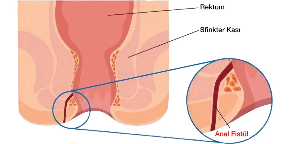 Fistül Nedir 1