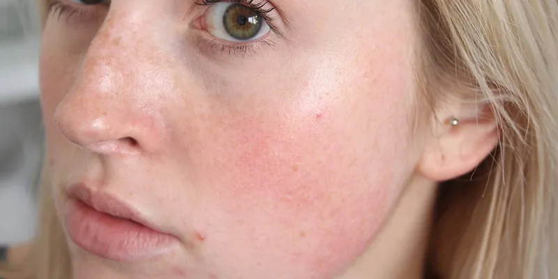 Gül Hastalığı Nedir 1