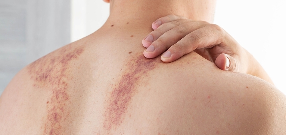 Hematom Ne Zaman Tehlikeli