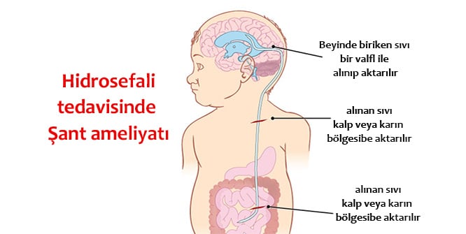 Hidrosefali Nedir 2