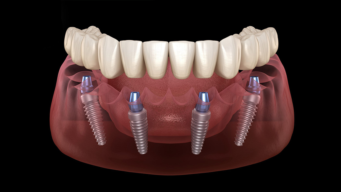 Implant Nedir 1